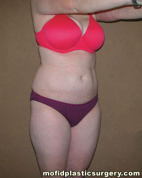 Liposuction Case 2314 Before Photo Liposuction