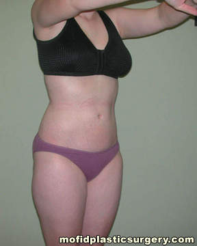 Liposuction Case 2314 After Photo Liposuction