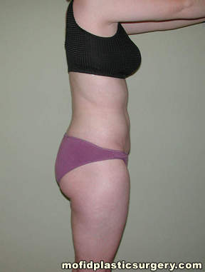 Liposuction Case 2314 After Photo Liposuction