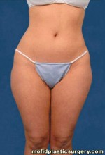 Liposuction