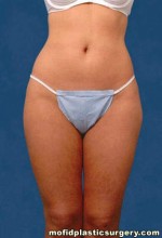 Liposuction