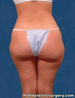 Liposuction