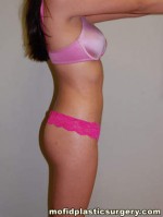 Liposuction