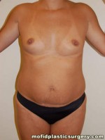 Liposuction