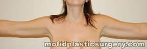 Liposuction Case 2362 After Photo Liposuction