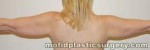Liposuction