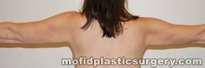 Liposuction Case 2362 After Photo Liposuction