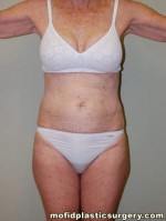 Liposuction