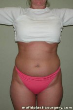 Liposuction