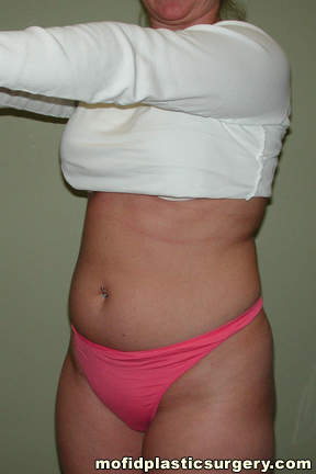 Liposuction Case 2376 Before Photo Liposuction