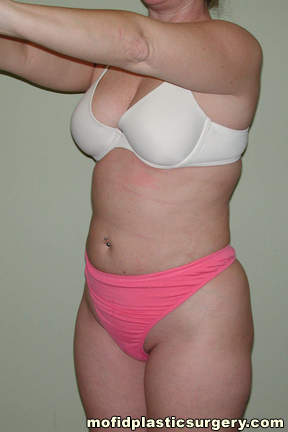 Liposuction Case 2376 After Photo Liposuction