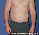 Liposuction