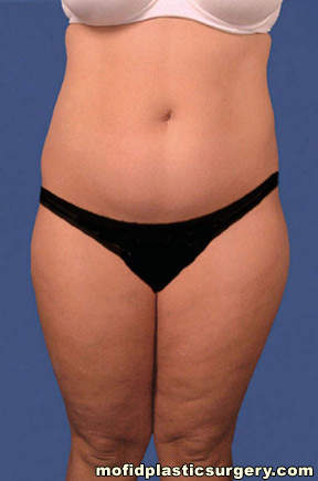 Liposuction