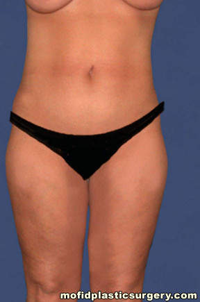 Liposuction