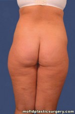 Liposuction