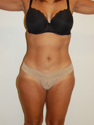 Liposuction Case 2400 Before Photo Liposuction