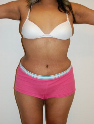Liposuction Case 2408 After Photo Liposuction