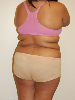 Liposuction Case 2408 Before Photo Liposuction