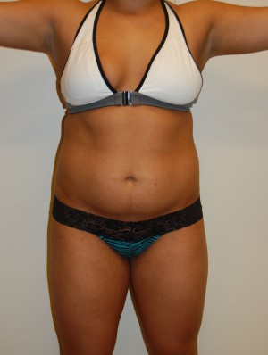 Liposuction Case 2426 Before Photo Liposuction