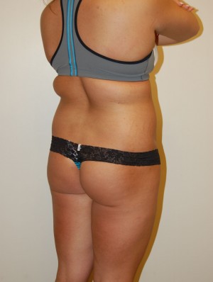 Liposuction Case 2426 Before Photo Liposuction