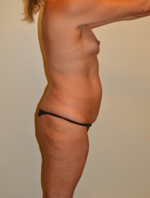 Tummy Tuck Case 2442 Before Photo Tummy Tuck