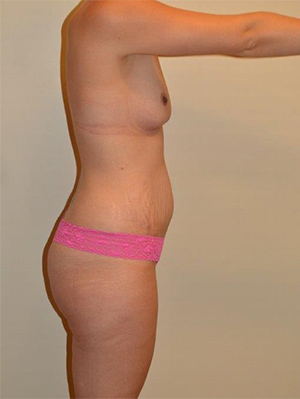 Tummy Tuck