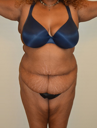 Tummy Tuck Case 2474 Before Photo Tummy Tuck