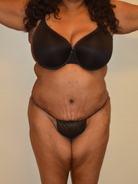 Tummy Tuck Case 2474 After Photo Tummy Tuck