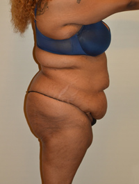Tummy Tuck Case 2474 Before Photo Tummy Tuck