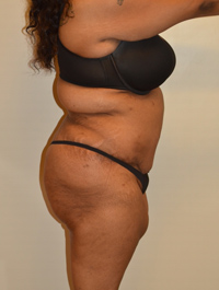 Tummy Tuck Case 2474 After Photo Tummy Tuck