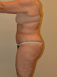 Tummy Tuck
