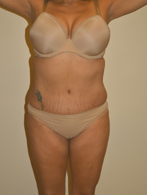 Tummy Tuck Case 2490 After Photo Tummy Tuck