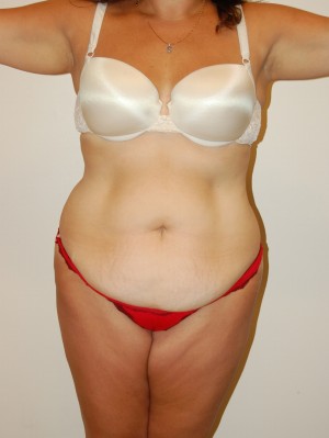 Tummy Tuck Case 2506 Before Photo Tummy Tuck