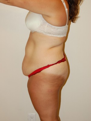 Tummy Tuck Case 2506 Before Photo Tummy Tuck