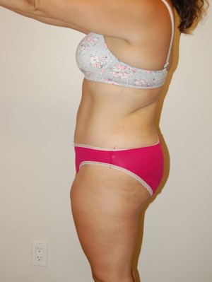 Tummy Tuck Case 2506 After Photo Tummy Tuck