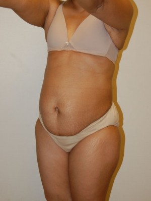 Tummy Tuck Case 2514 Before Photo Tummy Tuck