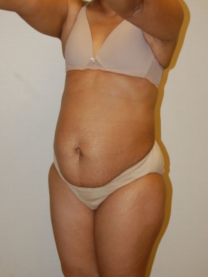 Tummy Tuck