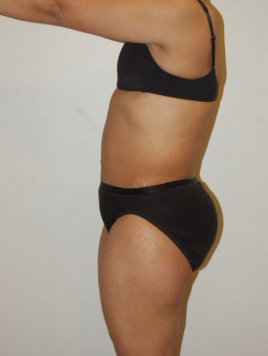 Tummy Tuck Case 2514 After Photo Tummy Tuck
