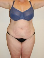 Tummy Tuck