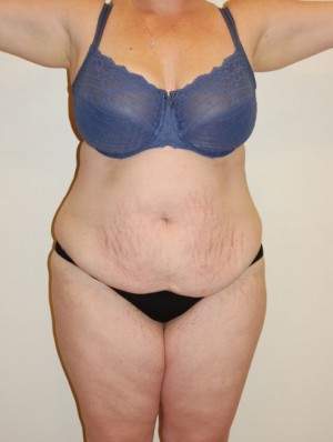 Tummy Tuck Case 2522 Before Photo Tummy Tuck