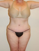 Tummy Tuck