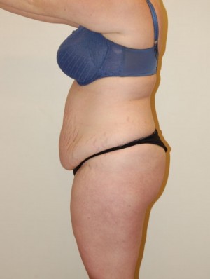 Tummy Tuck Case 2522 Before Photo Tummy Tuck