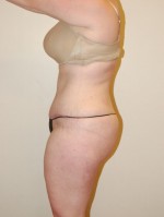 Tummy Tuck