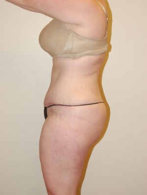 Tummy Tuck Case 2522 After Photo Tummy Tuck