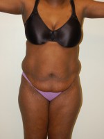 Tummy Tuck