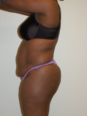 Tummy Tuck Case 2528 Before Photo Tummy Tuck