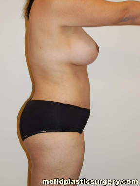 Tummy Tuck Case 2536 After Photo Tummy Tuck