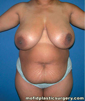 Tummy Tuck Case 2546 Before Photo Tummy Tuck