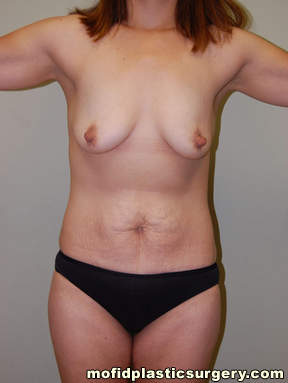 Tummy Tuck Case 2554 Before Photo Tummy Tuck