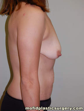 Tummy Tuck Case 2554 Before Photo Tummy Tuck